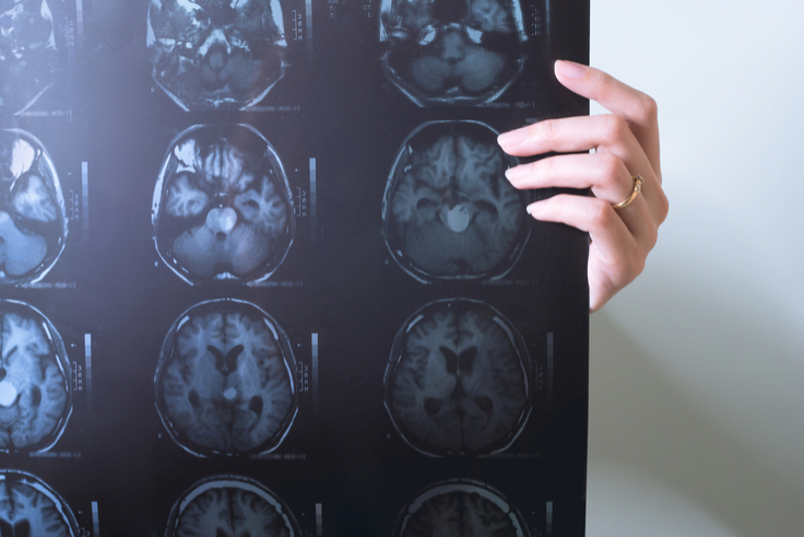 Targeted Resequencing Enables High-Throughput Detection of Somatic Mosaicism